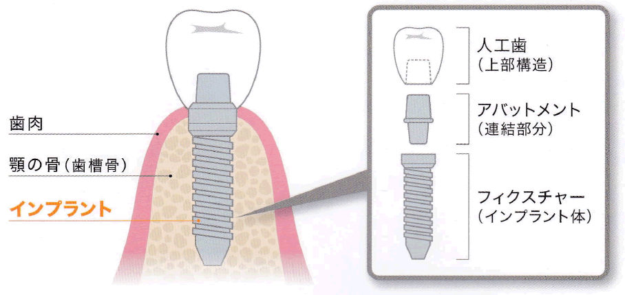 天然の歯に近い構造を持つインプラント